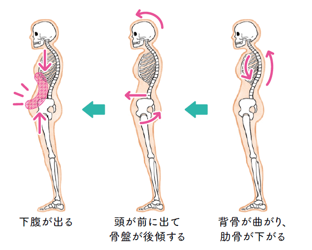 下腹が出る ← 頭が前に出て骨盤が後傾する ← 背骨が曲がり、肋骨が下がる